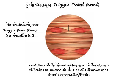 จุด Trigger Point (Knot) ในใยกล้ามเนื้อ